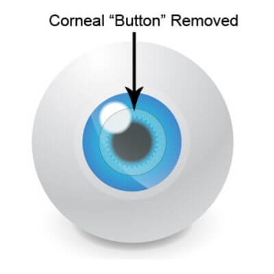 diagram of an eye saying “corneal ‘button’ removed”