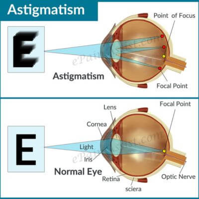 diagram of an eye with astigmatism vs an eye without it