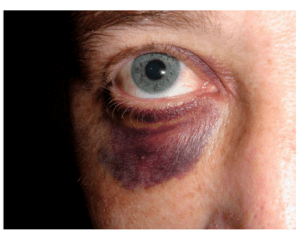 up-close image of a person with a black eye