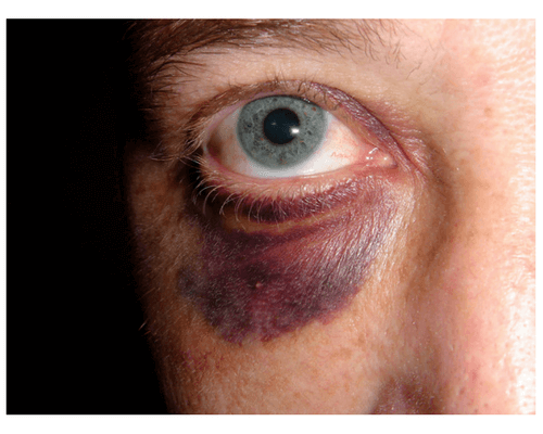 up-close image of a person with a black eye