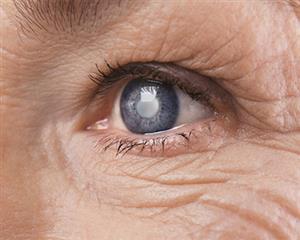 Causes & Symptoms Of Cataract Related Eye Conditions