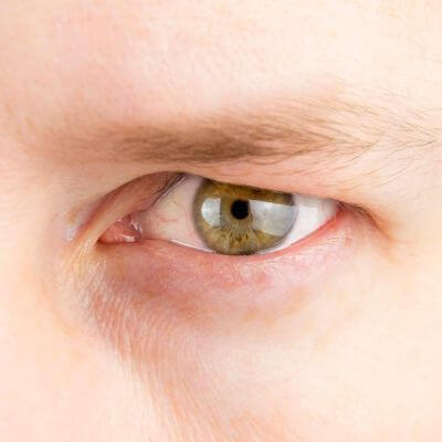 Hazel male pupil with a drooping eyelid