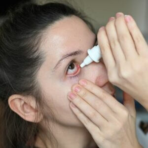 Young woman holds her eye open to use corneal ulcer-eye drops.