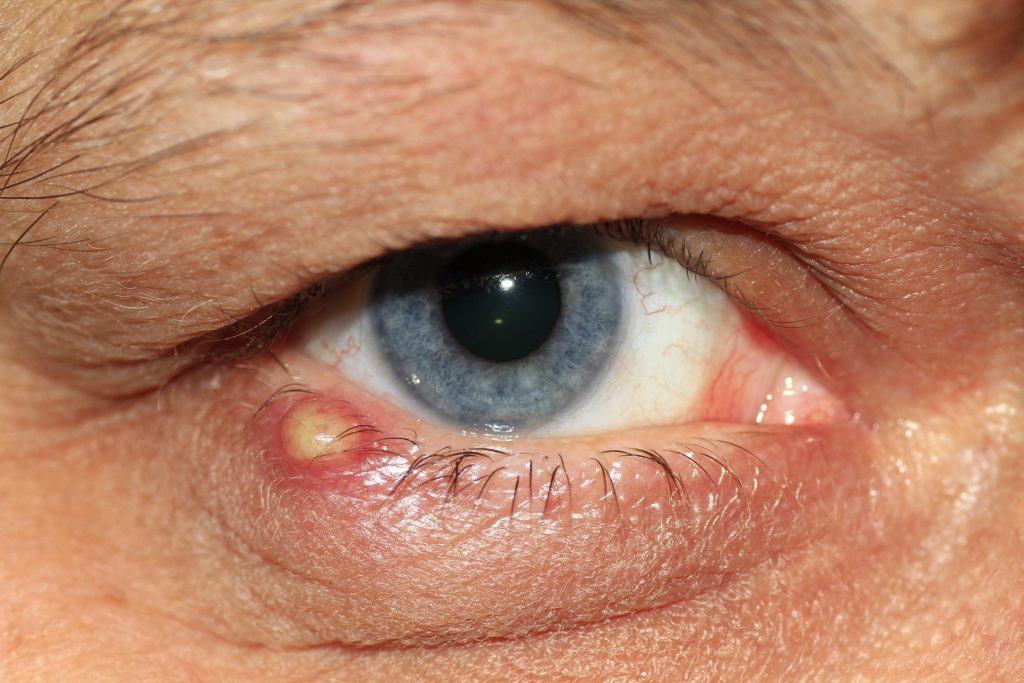 sore or swollen eyelid