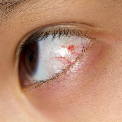 close-up of a person with broken blood vessels in their eye