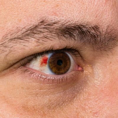 close-up of a man’s eye with a broken blood vessel