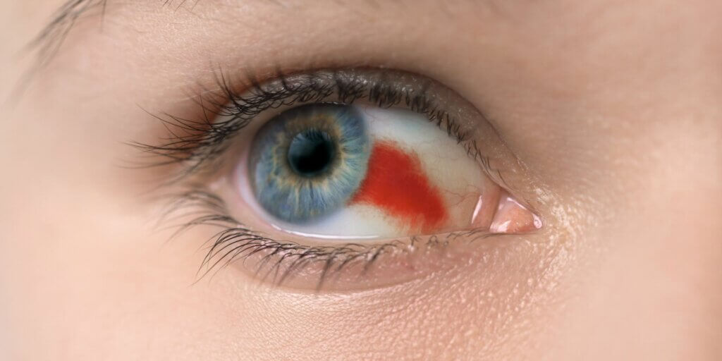 close-up image of a woman’s eye with a broken blood vessel