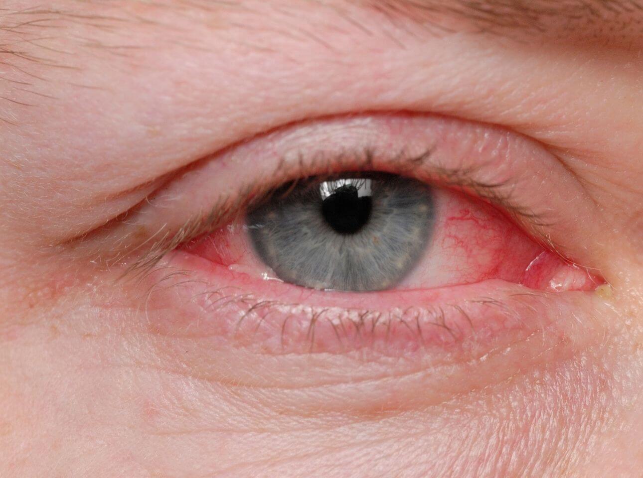 pink eye treatment
