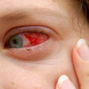 types of eye infections