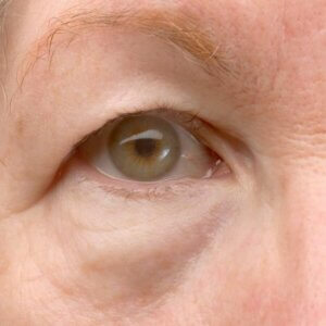 corrective eyelid surgery knovxville, tn