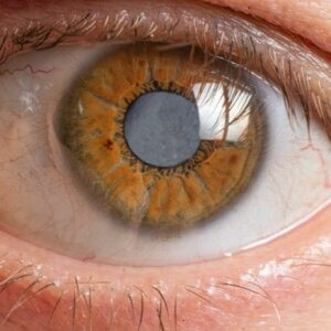 cataracts and diabetes