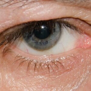 lower eyelid surgery