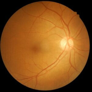 what is the first sign of diabetic retinopathy