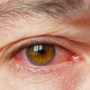 corneal disease list