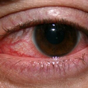 corneal ulcer causes