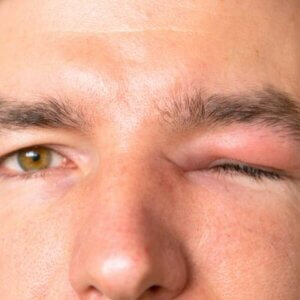 close-up of a caucasian man with a closed right eye due to upper eyelid pain