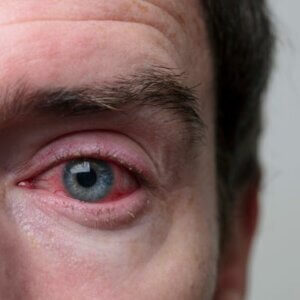 close-up of a caucasian man's right eye suffering from thyroid eye disease